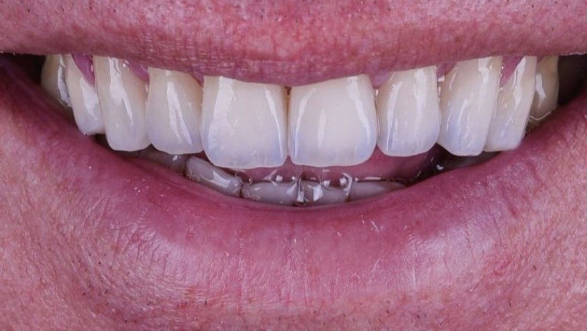 estética dental en Fuengirola