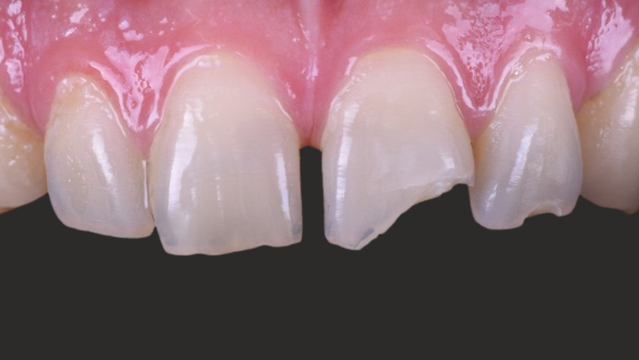 Antes urgencia dental