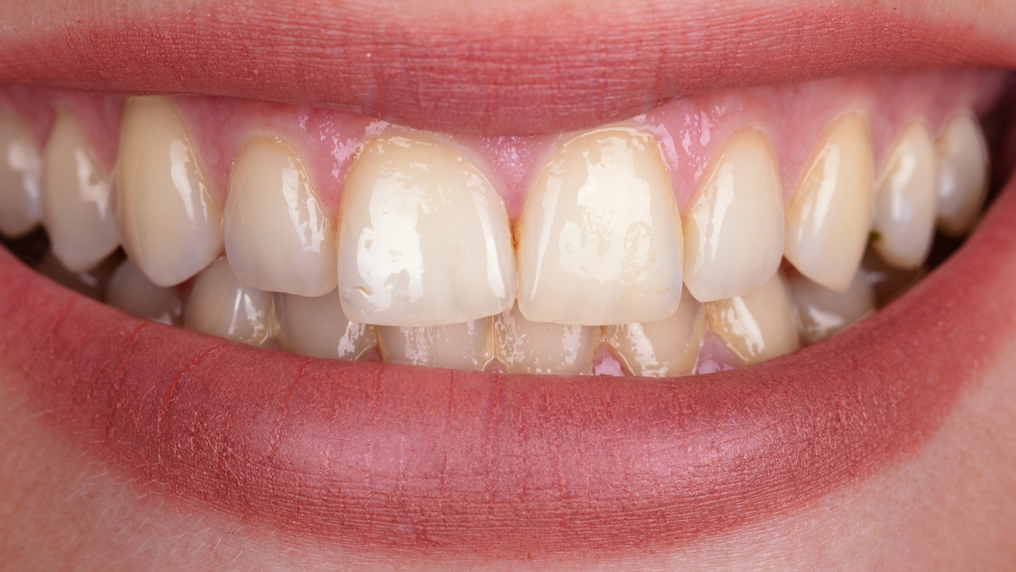 Blanqueamiento dental en Fuengirola