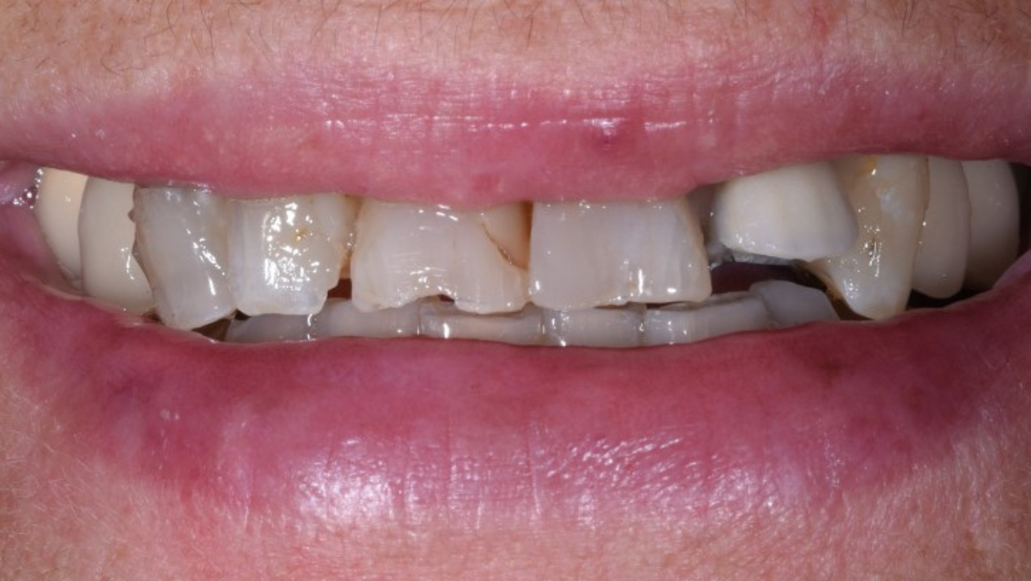 Carillas dentales Fuengirola