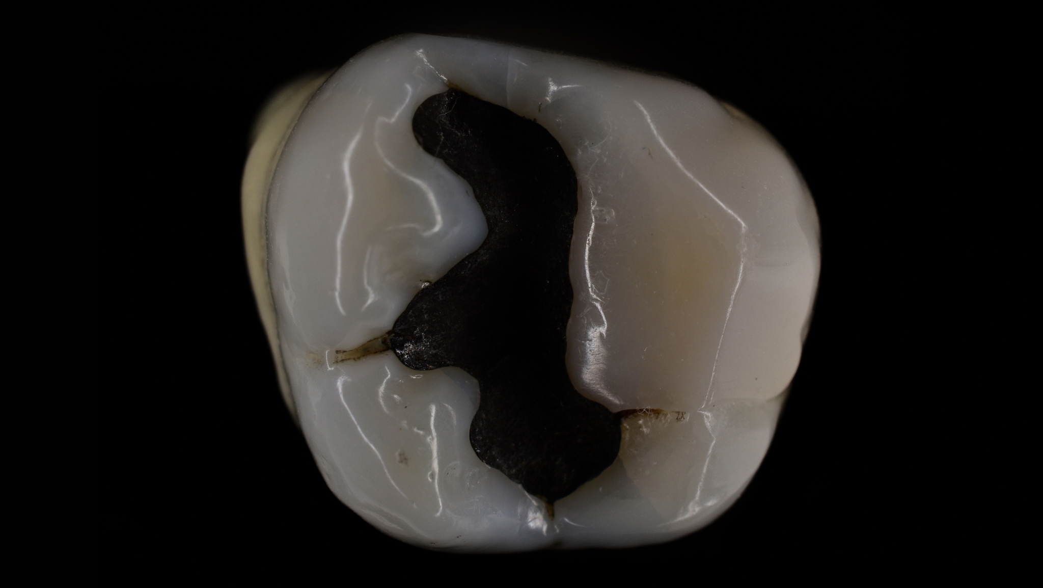 Antes empaste amalgama