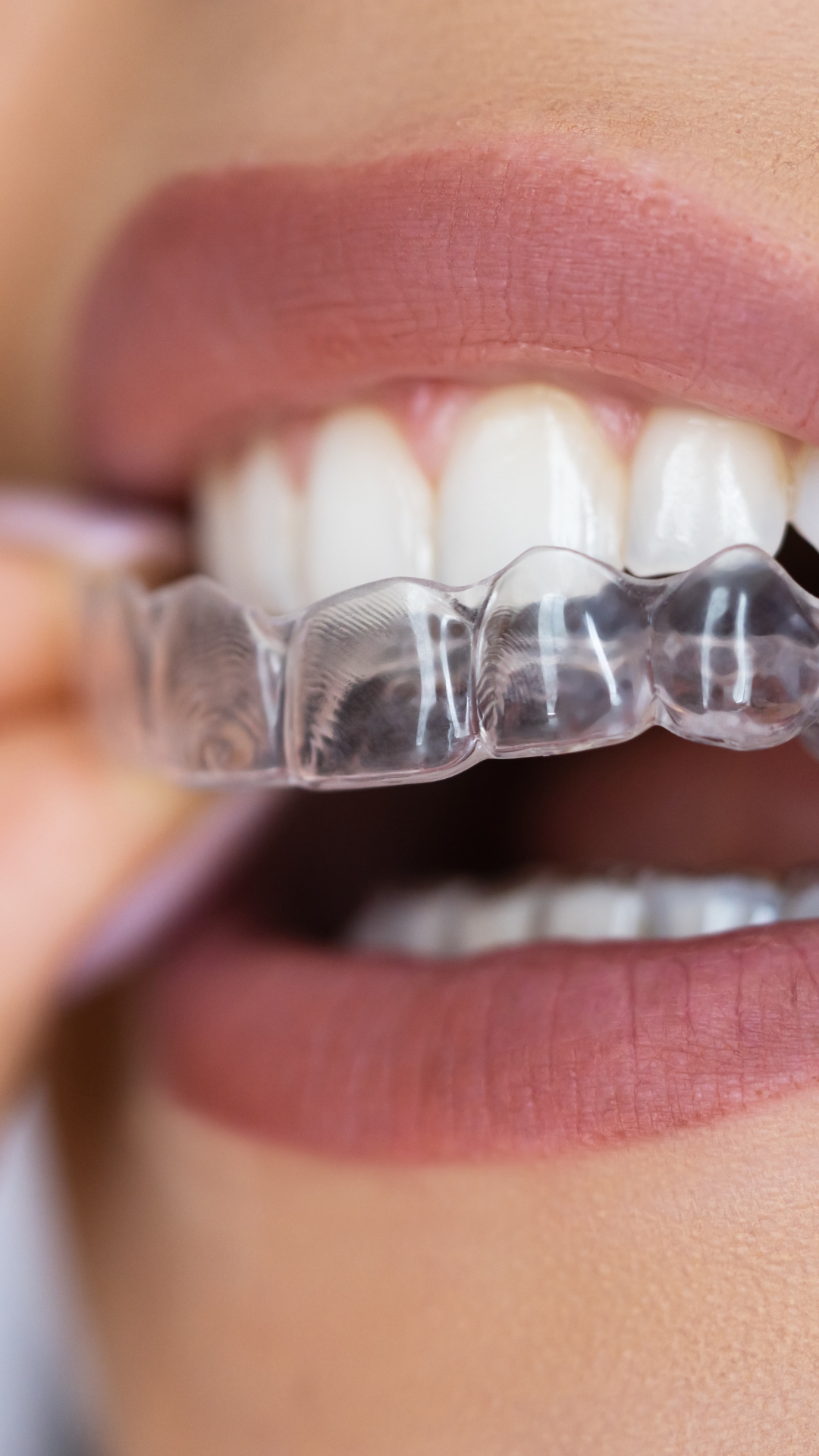 invisible orthodontics in Fuengirola