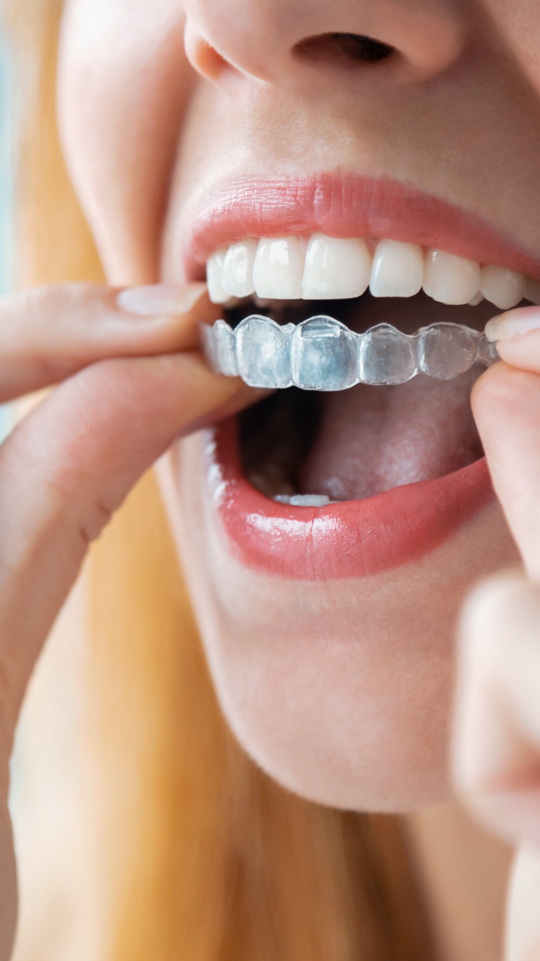 ortodoncia invisible en Fuengirola