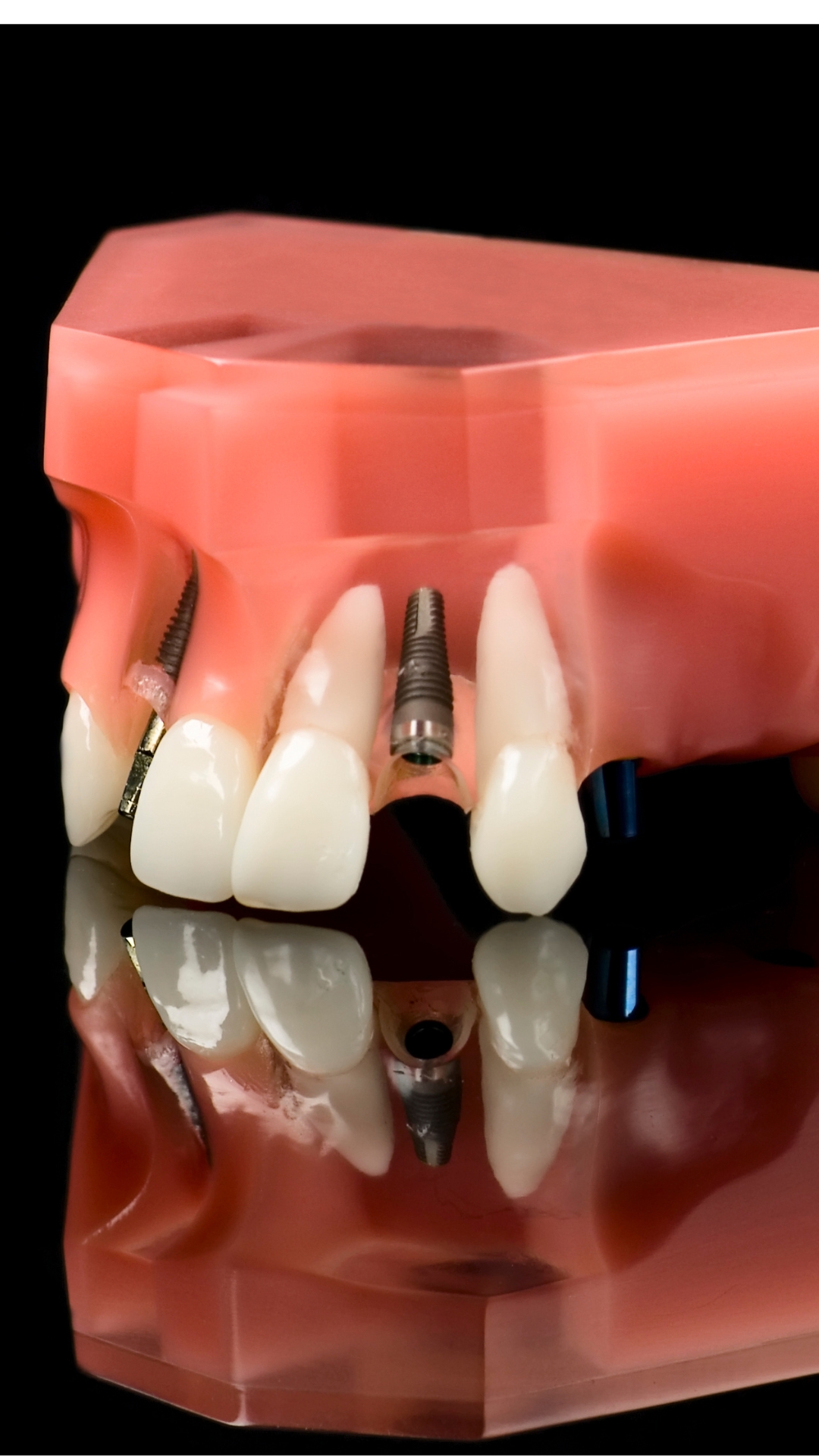 implantes dentales en Fuengirola