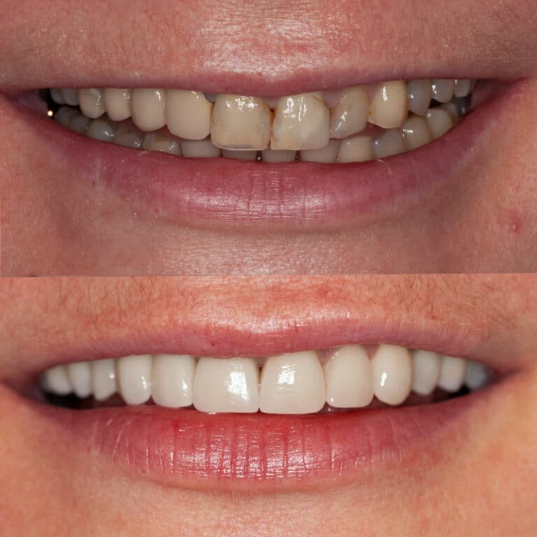 Antes y después de un tratamiento con carillas de composite