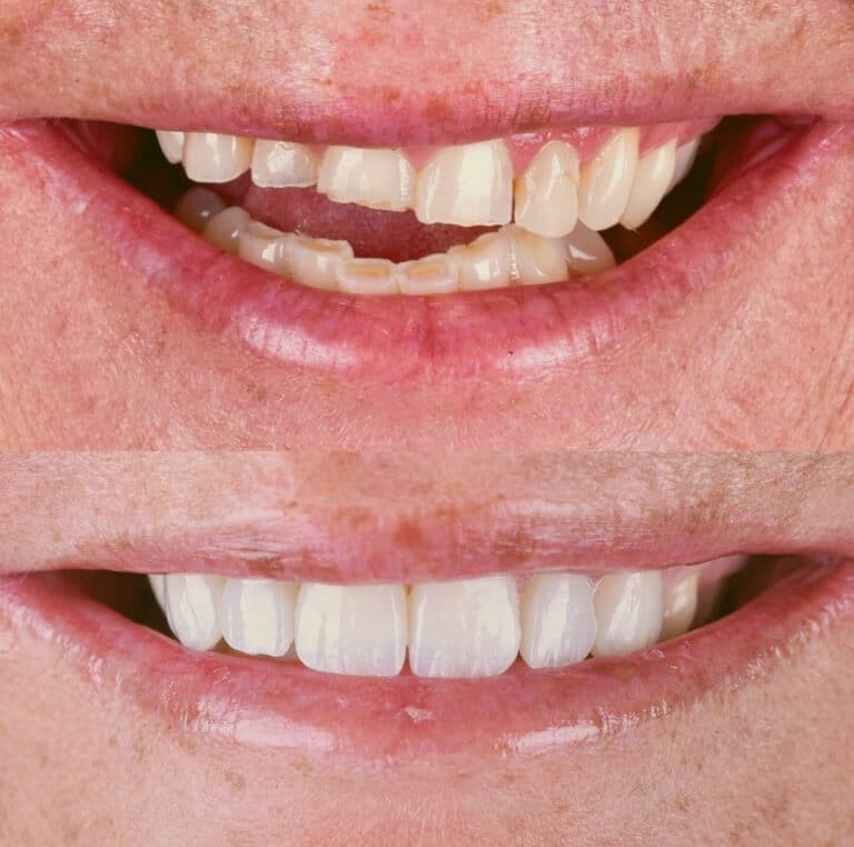 Antes y después de un tratamiento dental: dientes frontales