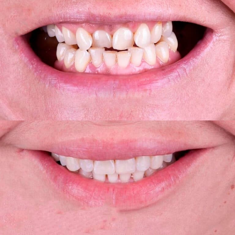 Antes y después de un tratamiento de ortodoncia