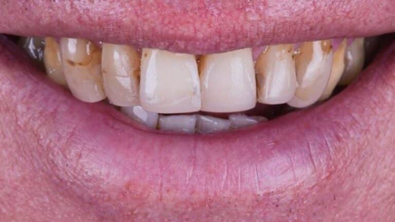 Sonrisa de un paciente antes del tratamiento