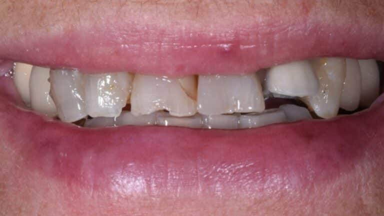 Sonrisa con los dientes desgastados y rotos antes de las carillas