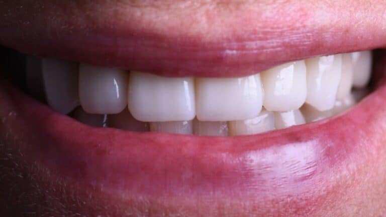 La misma sonrisa después de las carillas dentales
