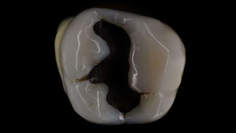 Muela con un empaste de amalgama antes del cambio