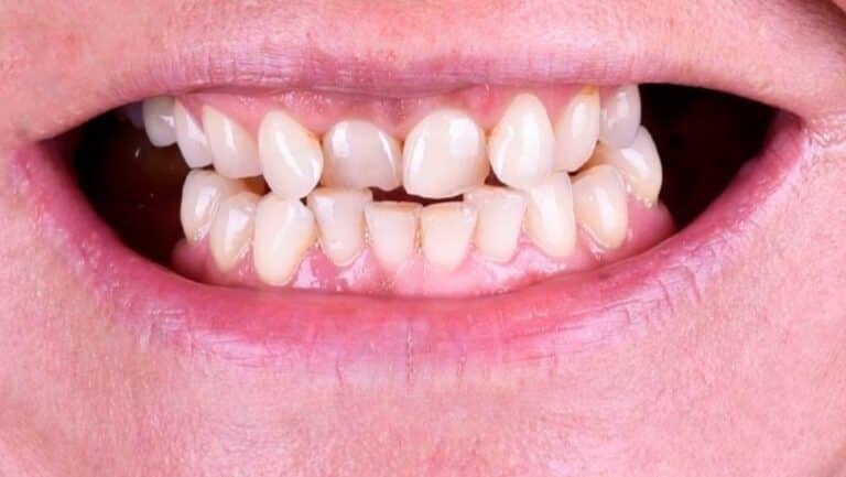 Dientes apiñados antes de la ortodoncia invisible