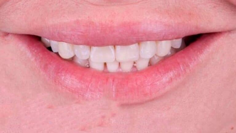 La misma sonrisa con los dientes alineados después de la ortodoncia invisible