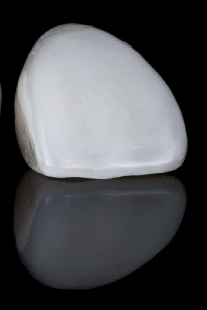 Carilla dental de cerámica