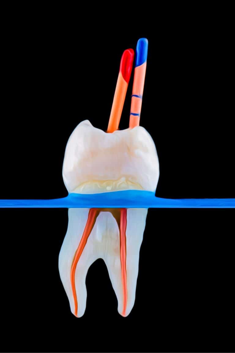 Muela con los conductos de la raíz en tratamiento de endodoncia